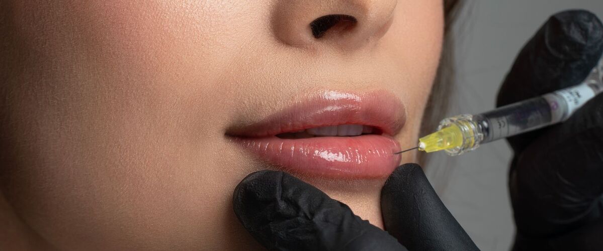 Lippenunterspritzung mit Hyaluronsäure